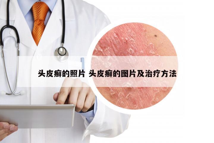 头皮癣的照片 头皮癣的图片及治疗方法