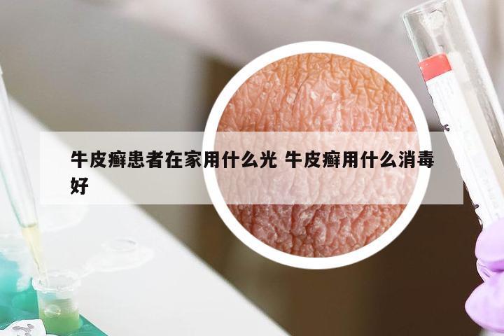 牛皮癣患者在家用什么光 牛皮癣用什么消毒好