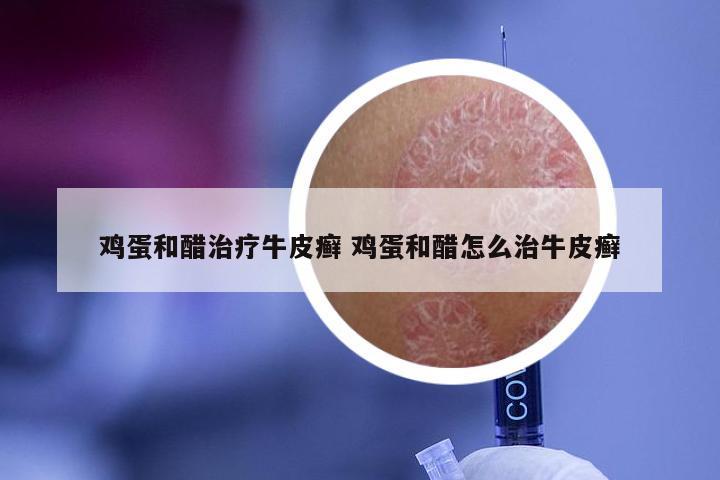 鸡蛋和醋治疗牛皮癣 鸡蛋和醋怎么治牛皮癣