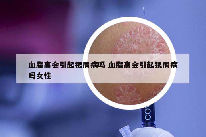 血脂高会引起银屑病吗 血脂高会引起银屑病吗女性