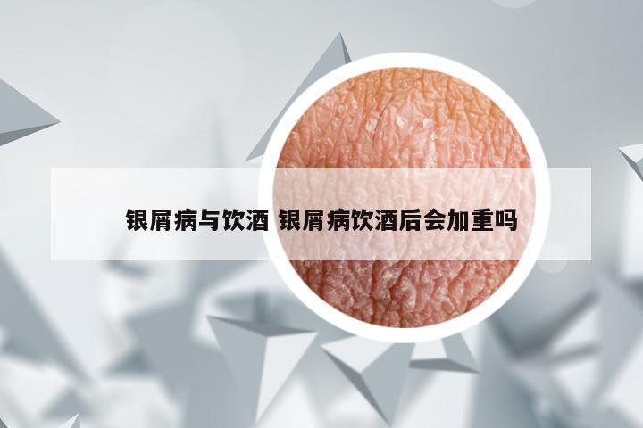 银屑病与饮酒 银屑病饮酒后会加重吗