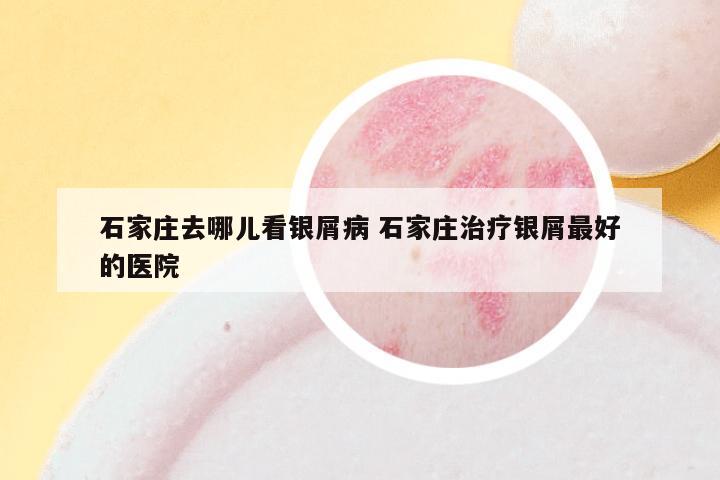 石家庄去哪儿看银屑病 石家庄治疗银屑最好的医院
