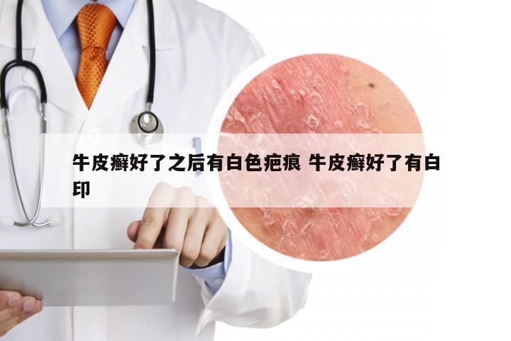 牛皮癣好了之后有白色疤痕 牛皮癣好了有白印