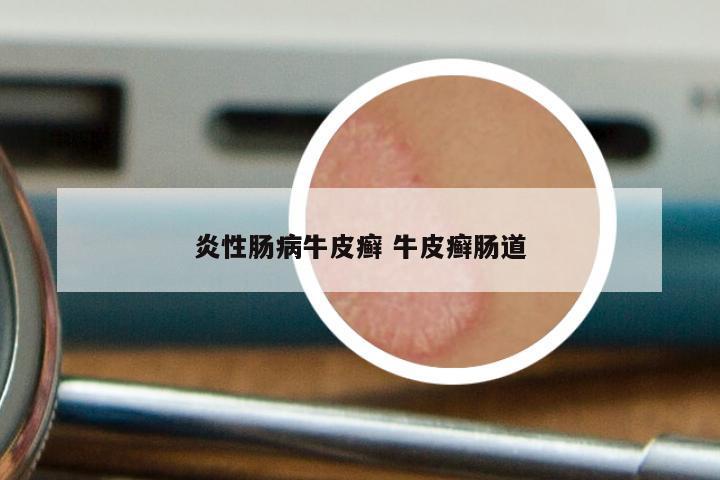 炎性肠病牛皮癣 牛皮癣肠道