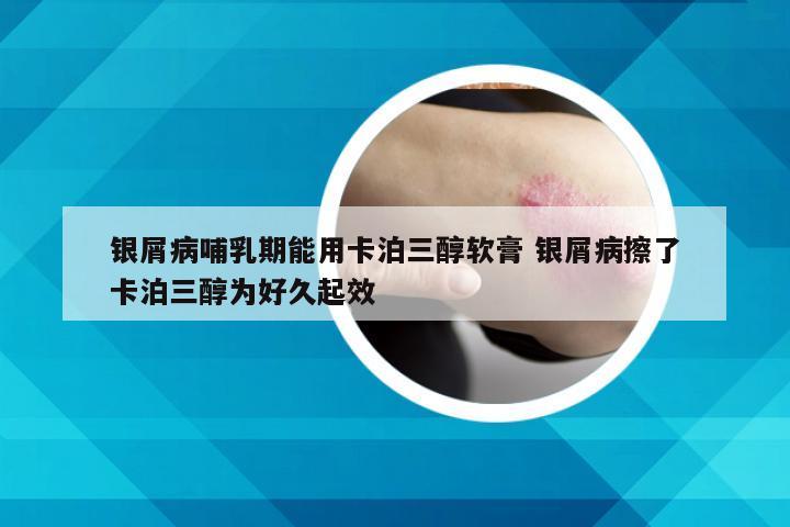 银屑病哺乳期能用卡泊三醇软膏 银屑病擦了卡泊三醇为好久起效
