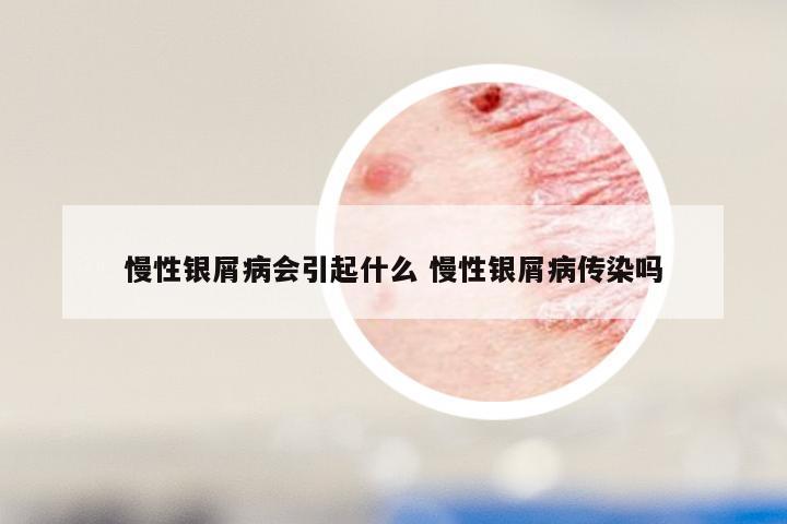 慢性银屑病会引起什么 慢性银屑病传染吗