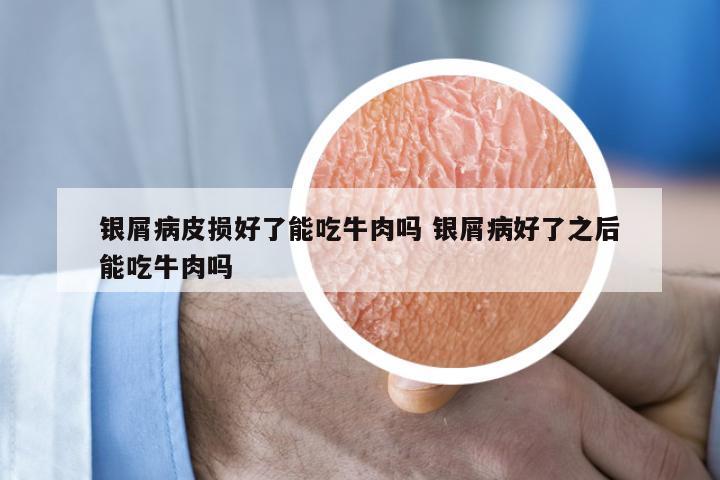 银屑病皮损好了能吃牛肉吗 银屑病好了之后能吃牛肉吗