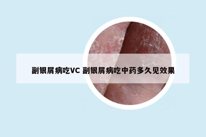 副银屑病吃VC 副银屑病吃中药多久见效果
