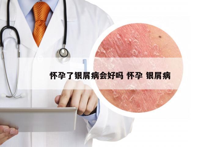 怀孕了银屑病会好吗 怀孕 银屑病
