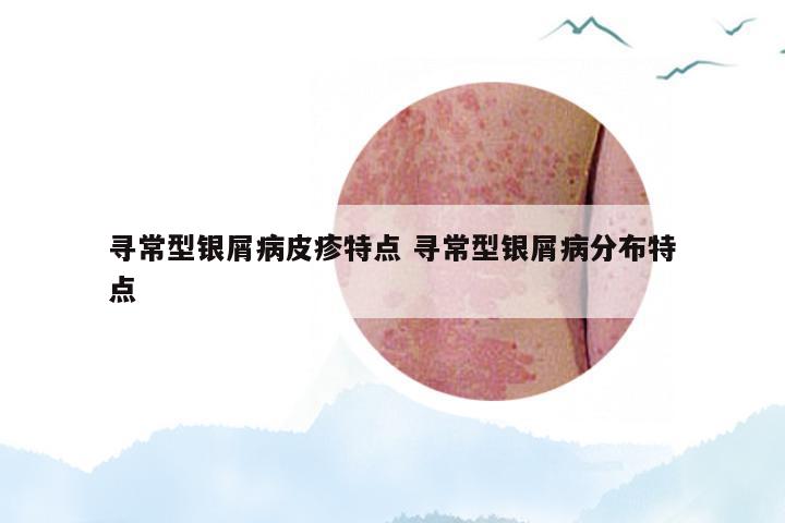 寻常型银屑病皮疹特点 寻常型银屑病分布特点