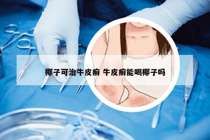 椰子可治牛皮癣 牛皮癣能喝椰子吗