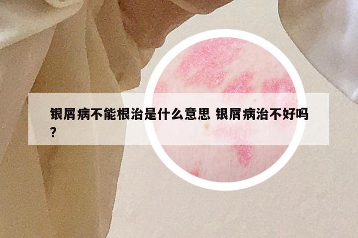 银屑病不能根治是什么意思 银屑病治不好吗?