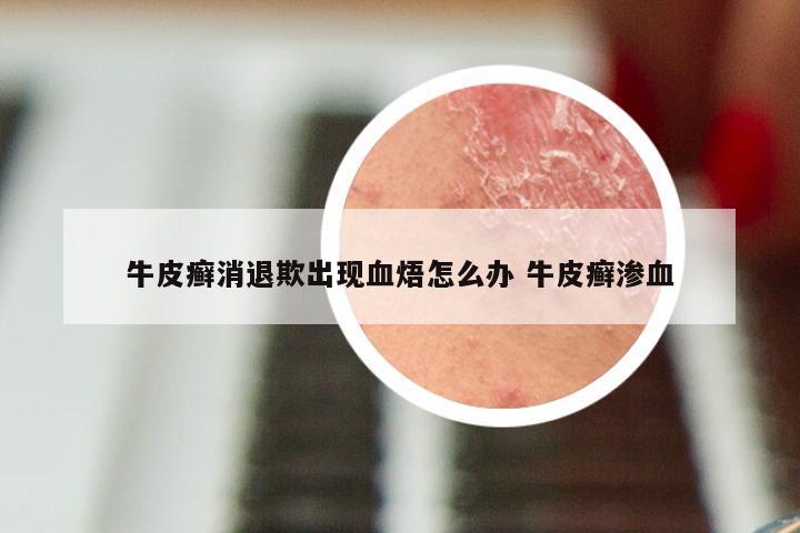 牛皮癣消退欺出现血焐怎么办 牛皮癣渗血