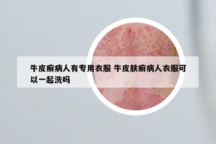 牛皮癣病人有专用衣服 牛皮肤癣病人衣服可以一起洗吗