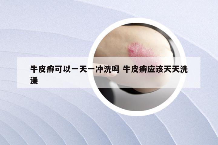 牛皮癣可以一天一冲洗吗 牛皮癣应该天天洗澡