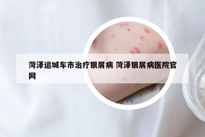 菏泽运城车市治疗银屑病 菏泽银屑病医院官网