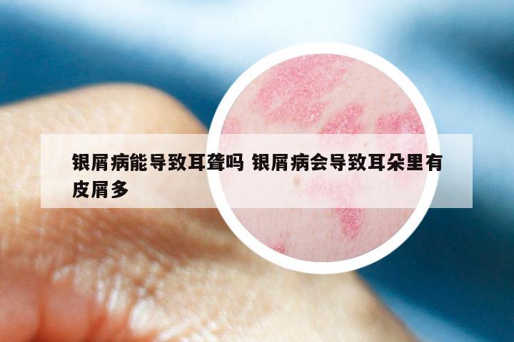 银屑病能导致耳聋吗 银屑病会导致耳朵里有皮屑多