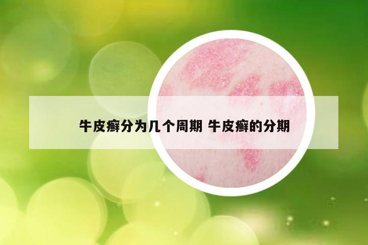 牛皮癣分为几个周期 牛皮癣的分期