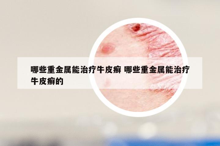 哪些重金属能治疗牛皮癣 哪些重金属能治疗牛皮癣的