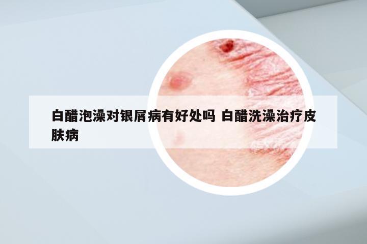 白醋泡澡对银屑病有好处吗 白醋洗澡治疗皮肤病
