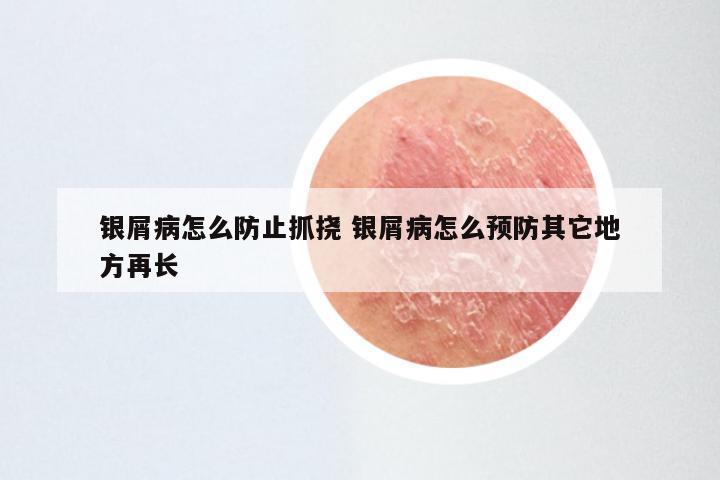 银屑病怎么防止抓挠 银屑病怎么预防其它地方再长