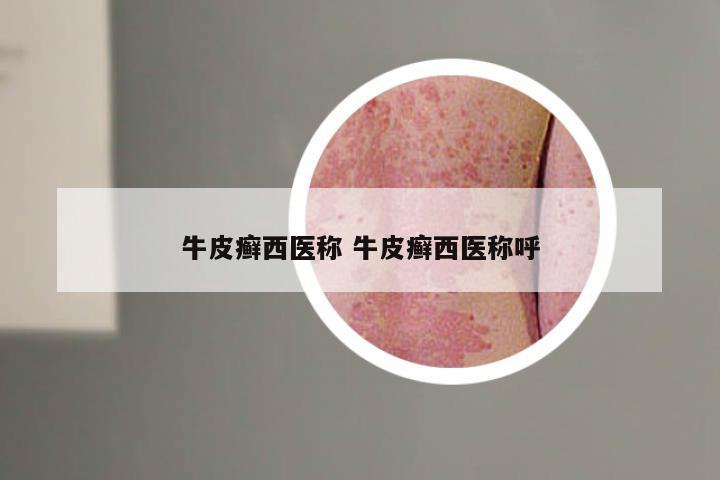牛皮癣西医称 牛皮癣西医称呼