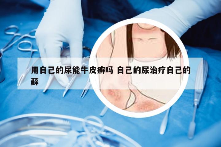 用自己的尿能牛皮癣吗 自己的尿治疗自己的藓