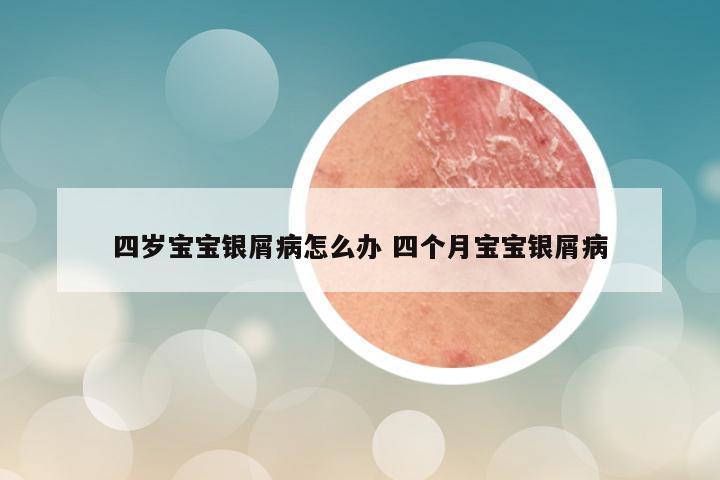 四岁宝宝银屑病怎么办 四个月宝宝银屑病
