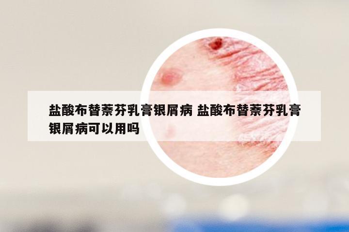 盐酸布替萘芬乳膏银屑病 盐酸布替萘芬乳膏银屑病可以用吗