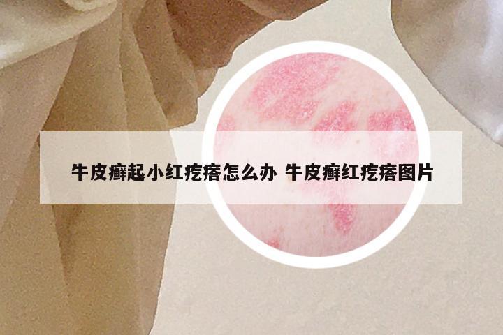 牛皮癣起小红疙瘩怎么办 牛皮癣红疙瘩图片