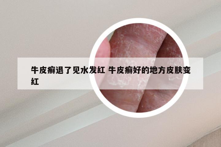 牛皮癣退了见水发红 牛皮癣好的地方皮肤变红