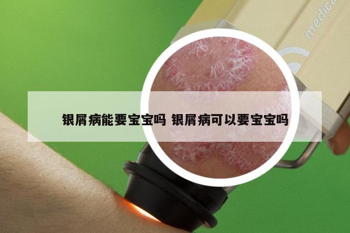 银屑病能要宝宝吗 银屑病可以要宝宝吗