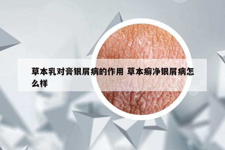 草本乳对膏银屑病的作用 草本癣净银屑病怎么样