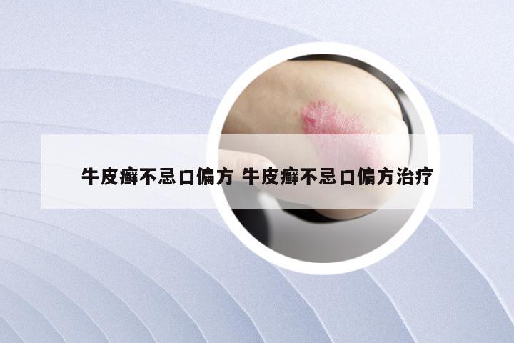 牛皮癣不忌口偏方 牛皮癣不忌口偏方治疗