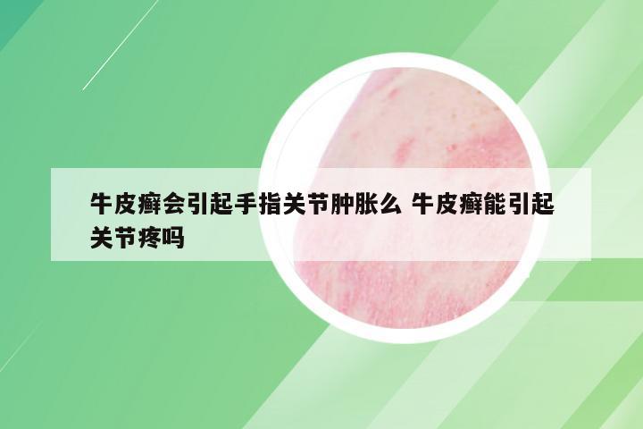 牛皮癣会引起手指关节肿胀么 牛皮癣能引起关节疼吗