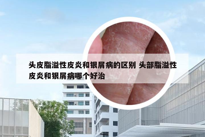 头皮脂溢性皮炎和银屑病的区别 头部脂溢性皮炎和银屑病哪个好治