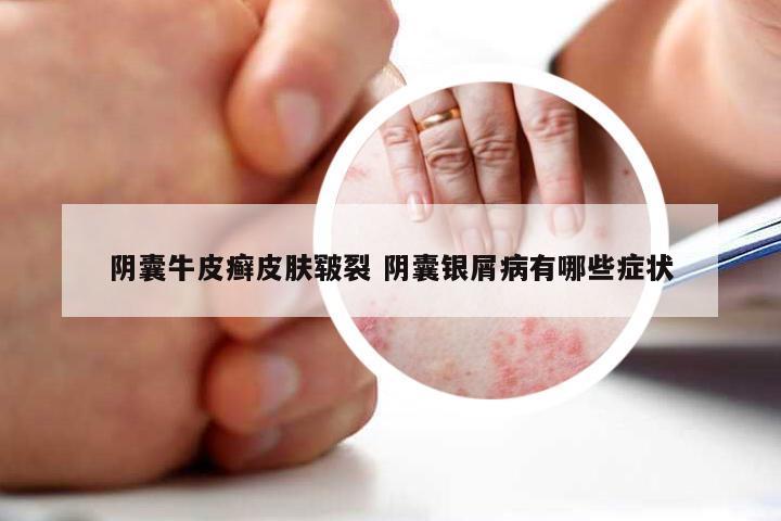 阴囊牛皮癣皮肤皲裂 阴囊银屑病有哪些症状