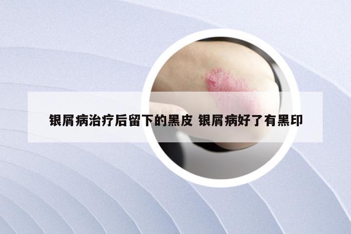银屑病治疗后留下的黑皮 银屑病好了有黑印