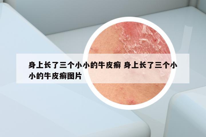 身上长了三个小小的牛皮癣 身上长了三个小小的牛皮癣图片