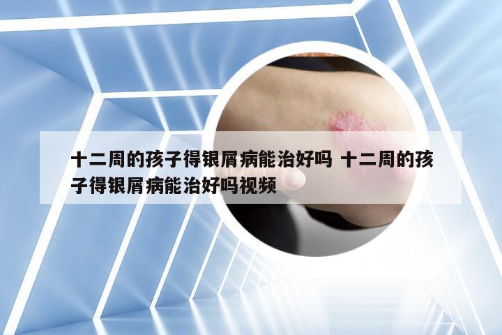 十二周的孩子得银屑病能治好吗 十二周的孩子得银屑病能治好吗视频