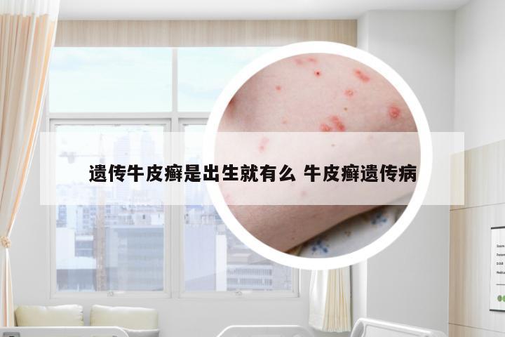 遗传牛皮癣是出生就有么 牛皮癣遗传病