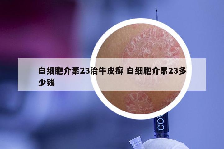 白细胞介素23治牛皮癣 白细胞介素23多少钱