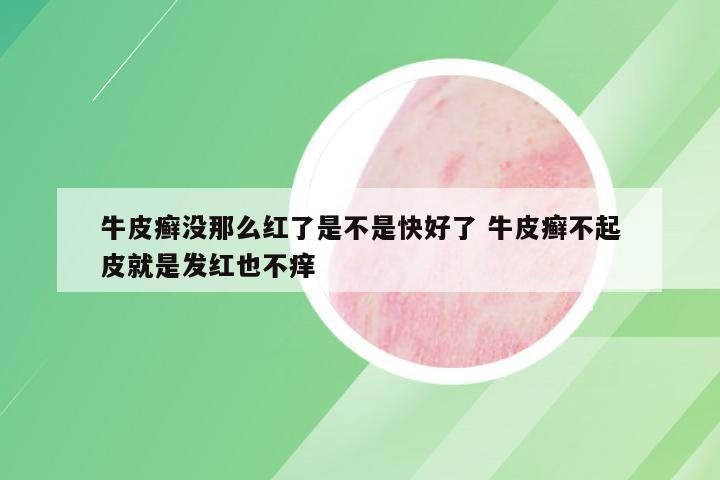 牛皮癣没那么红了是不是快好了 牛皮癣不起皮就是发红也不痒