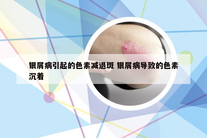 银屑病引起的色素减退斑 银屑病导致的色素沉着