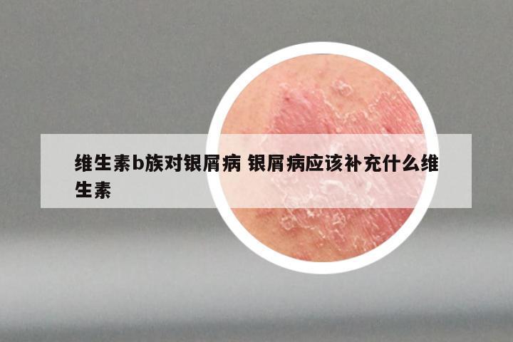 维生素b族对银屑病 银屑病应该补充什么维生素
