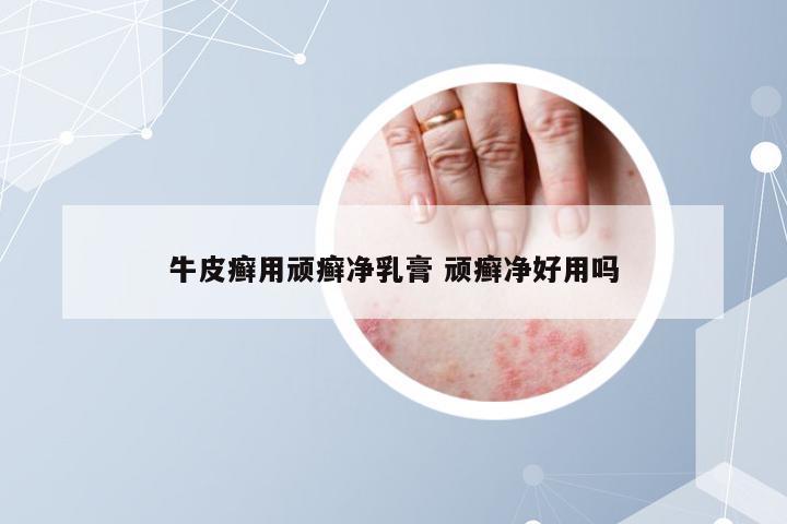 牛皮癣用顽癣净乳膏 顽癣净好用吗