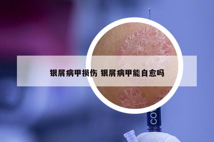 银屑病甲损伤 银屑病甲能自愈吗