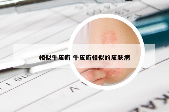 相似牛皮癣 牛皮癣相似的皮肤病