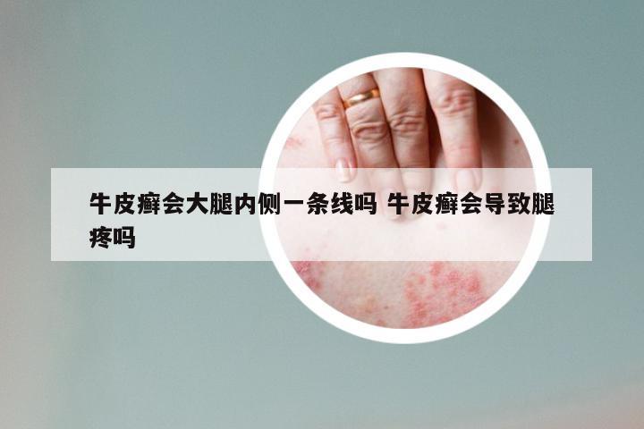 牛皮癣会大腿内侧一条线吗 牛皮癣会导致腿疼吗