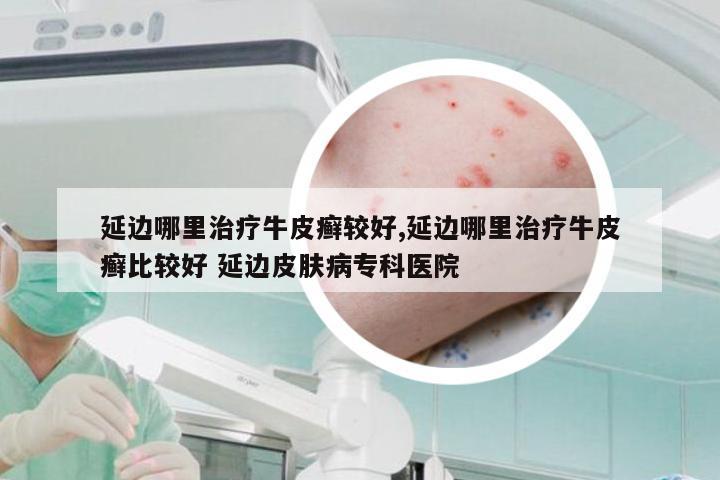 延边哪里治疗牛皮癣较好,延边哪里治疗牛皮癣比较好 延边皮肤病专科医院